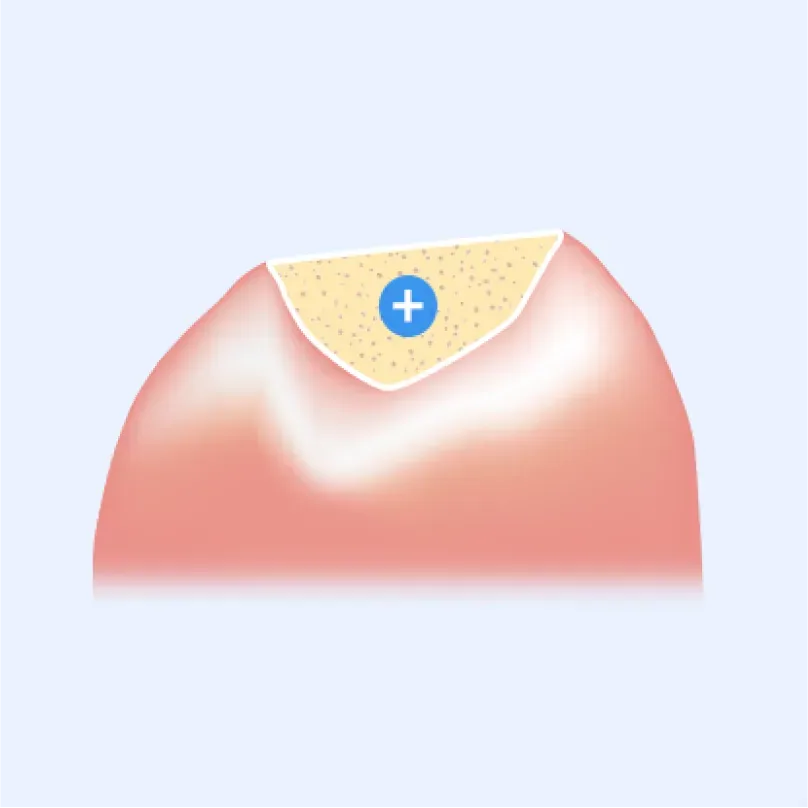 부족한 자리에 뼈이식재를 채우는 그림
