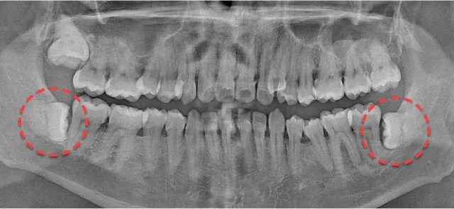 발치 전 파노라마 X-ray. 양쪽 아래 매복 사랑니를 빨간 점선으로 표시