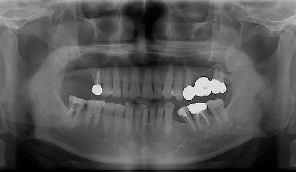 실제 부모님 임플란트 수술 전 파노라마 X-ray