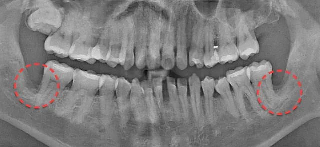 발치 후 파노라마 X-ray. 양쪽 사랑니가 빠진 자리를 빨간 점선으로 표시