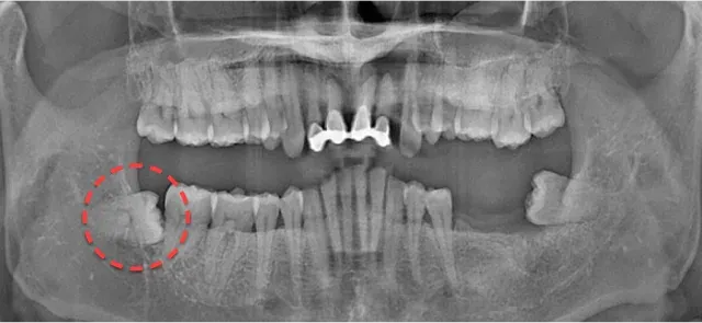 발치 전 파노라마 X-ray. 오른쪽 아래 매복 사랑니를 빨간 점선으로 표시