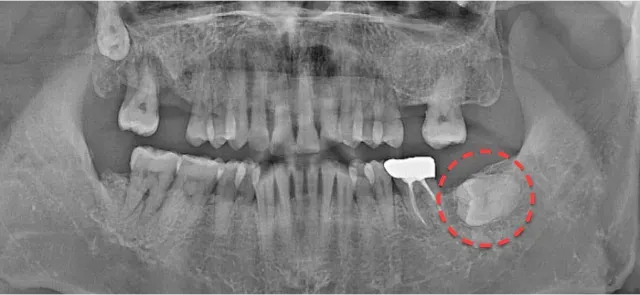 발치 전 파노라마 X-ray. 왼쪽 아래 매복 사랑니를 빨간 점선으로 표시