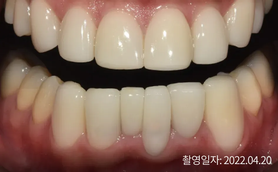 라미네이트 치료 후 가지런한 앞니(촬영일자 2022.04.20)