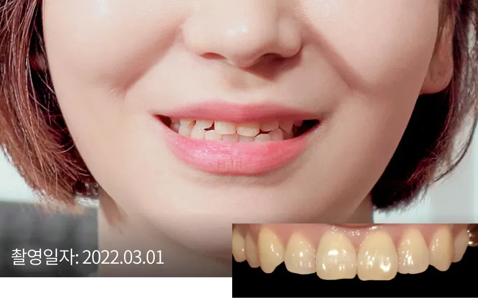 라미네이트 치료 전 웃는 입과 앞니 확대(촬영일자 2022.03.01)