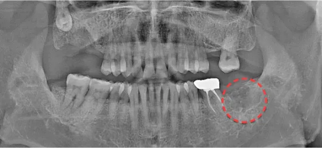 발치 후 파노라마 X-ray. 사랑니가 빠진 자리를 빨간 점선으로 표시