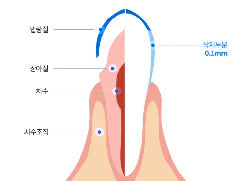 치아 단면 그림. 법랑질·상아질·치수·치수조직과 겉면 삭제 부분 0.1mm 표시