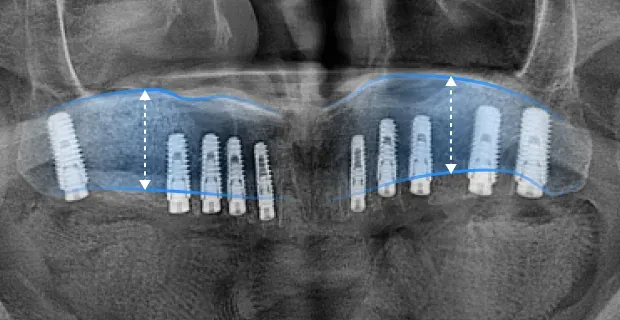 상악동 거상술 후 파노라마 X-ray. 파란 선으로 높아진 경계와 심은 임플란트를 표시
