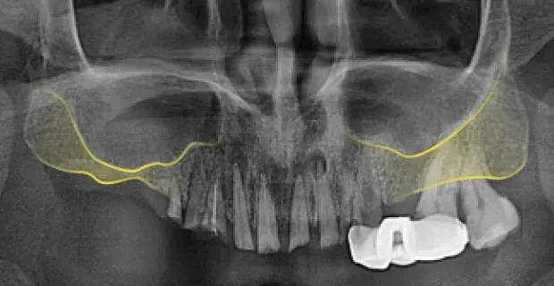 상악동 거상술 전 파노라마 X-ray. 노란 선으로 잇몸뼈와 상악동의 경계를 표시