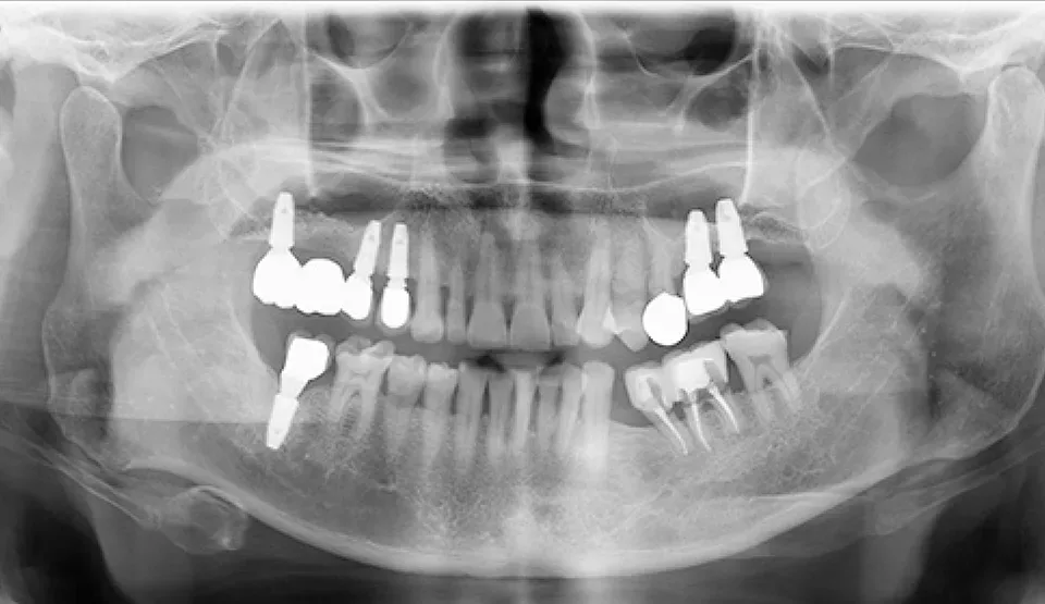실제 부모님 임플란트 수술 1년 뒤 파노라마 X-ray