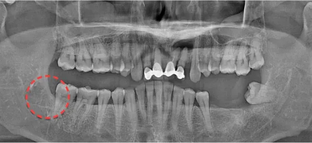 발치 후 파노라마 X-ray. 사랑니가 빠진 자리를 빨간 점선으로 표시
