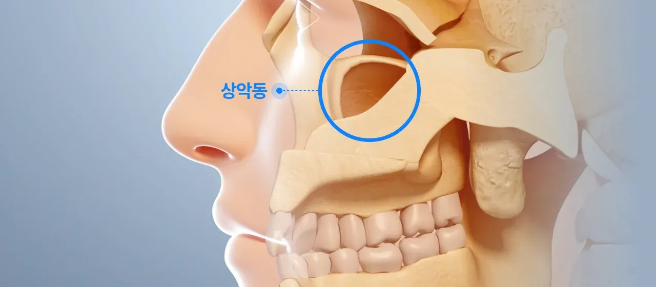 위턱뼈 속 빈 공간인 상악동의 위치를 표시한 얼굴 옆모습 그림