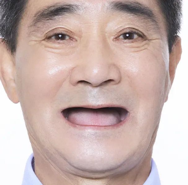 옥**님 60대 치료 전
