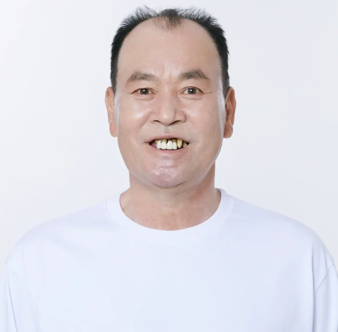 김**님 60대 임플란트 (서울점) 치료 전