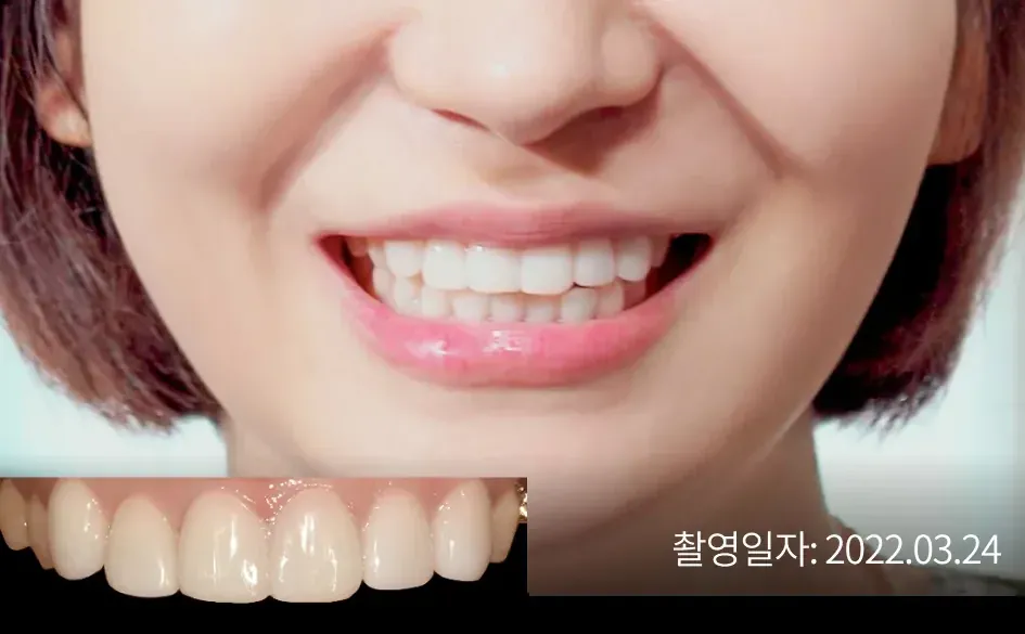 라미네이트 치료 사례 1 (서울점) 치료 후